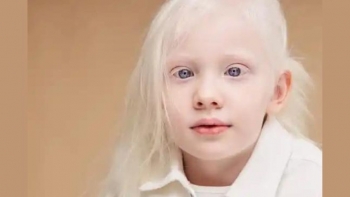 Comunidade albina moçambicana diz ser alvo de discriminação